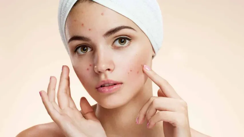 Face Pimples: ముఖంపై మొటిమలు మాయం చేసే ఇంటి చిట్కాలు