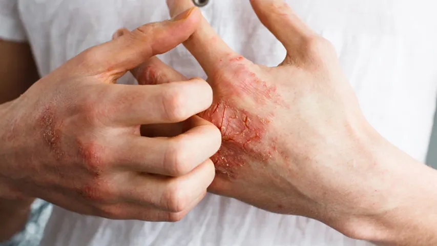 'A' Vitamin Deficiency: ఏ విటమిన్‌ లోపంతో ఏ వ్యాధి వస్తుంది?.. లోపాన్ని ఎలా అధిగమించాలి..?