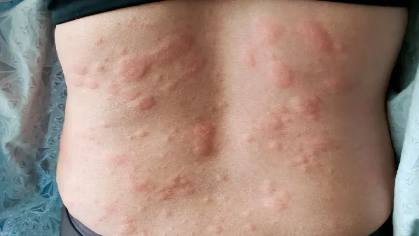Skin Swelling : కీటకాలు కుట్టిన చోట చర్మం ఎందుకు ఉబ్బుతుంది?