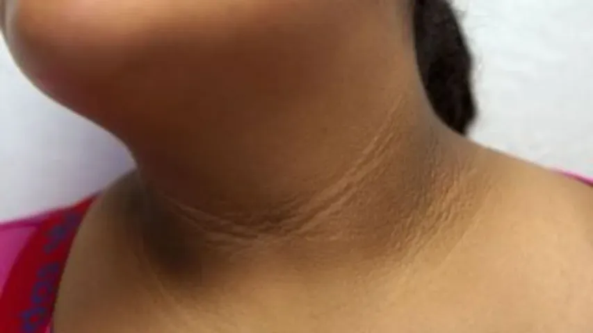 Neck Black: మెడ నల్లగా మారడం దేనికి సంకేతం..ఈ అవయవానికి ముప్పుతప్పదా?