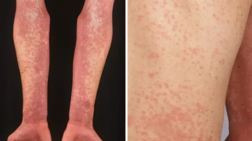 Scarlet Fever : చిన్నారుల్లో పెరుగుతున్న స్కార్లెట్‌ ఫీవర్‌.. నిర్లక్ష్యం చేయవద్దు!