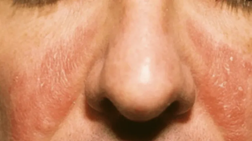 Body Rashes : శరీరంపై దద్దుర్లు ఈ వ్యాధి లక్షణమేనా?..ఎందుకొస్తుందో తెలుసా?