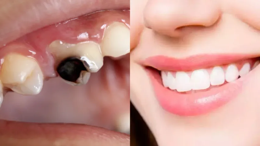 Teeth Tips: పుచ్చిన దంతాలను రిపేర్‌ చేసే టెక్నిక్‌.. కొత్తవాటిలా మెరుస్తాయి