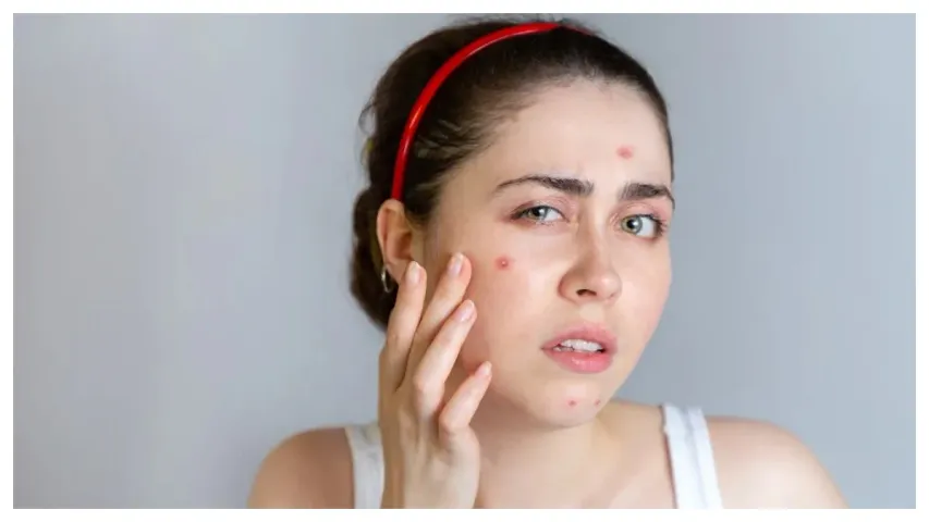 Health: మొటిమలు వదిలించుకోవడానికి కొన్ని చిట్కాలు!
