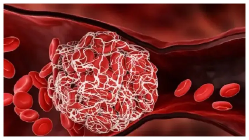Health : శరీరంలో రక్తం గడ్డ కడితే.. మనలో కనిపించే లక్షణాలు ఇవే!