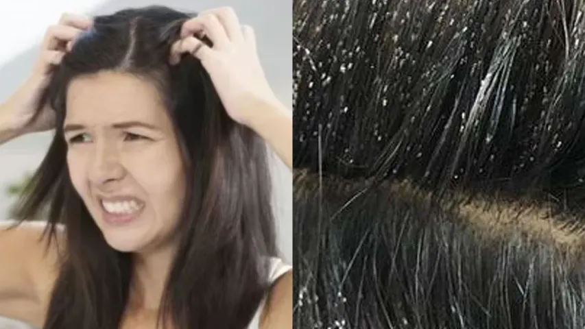 Head Tips: తలలో పేలను సులభంగా తరిమికొట్టండి..మళ్లీ జీవితంలో రావు