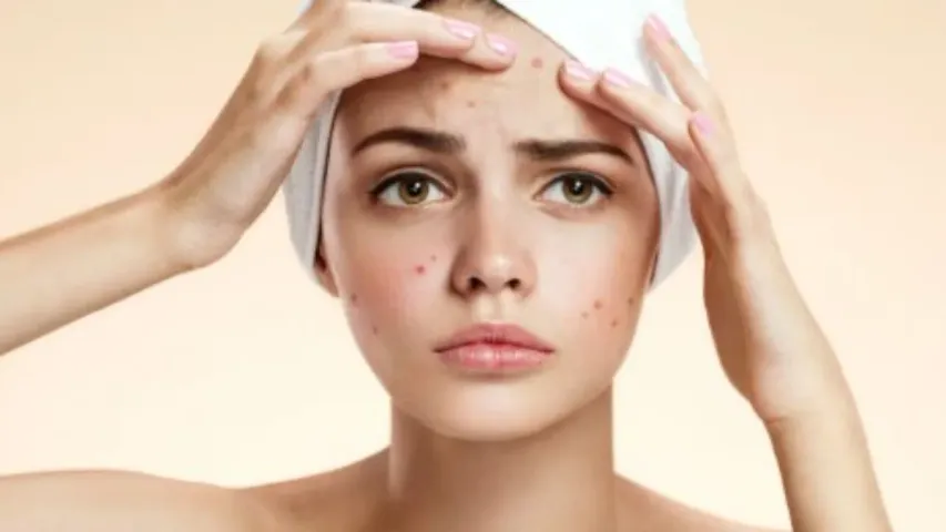 Pimples Tips: మొటిమలు మిమ్మల్ని వేధిస్తున్నాయా..? ఇలా ఉపశమనం పొందండి