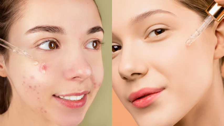 Beauty Tips: ఏళ్లనాటి మచ్చలు క్షణాల్లో పోవాలంటే.. ఈ సీరమ్‌ను వాడండి
