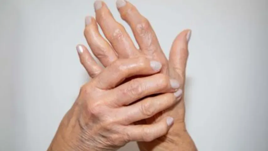 Arthritis Symptoms: ఈ లక్షణాలు ఆర్థరైటిస్‌కు సూచనలా? తప్పక తెలుసుకోండి