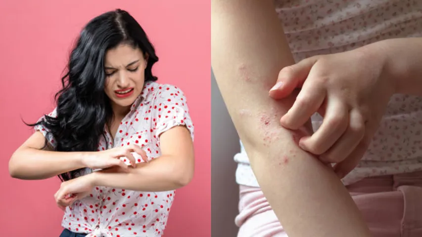 Summer Health Tips: వేడి కారణంగా కూడా అలెర్జీ వస్తుందా..? నివారణా మార్గాలను తెలుసుకోండి