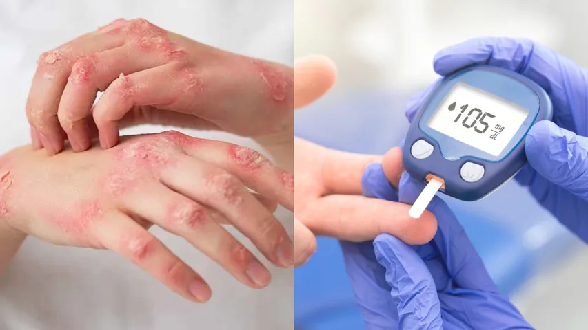 Diabetes Symptoms: చర్మంపై కనిపించే ఈ సమస్యలను తేలికగా తీసుకోకండి.. డయాబెటిస్‌కు సంకేతం కావచ్చు.