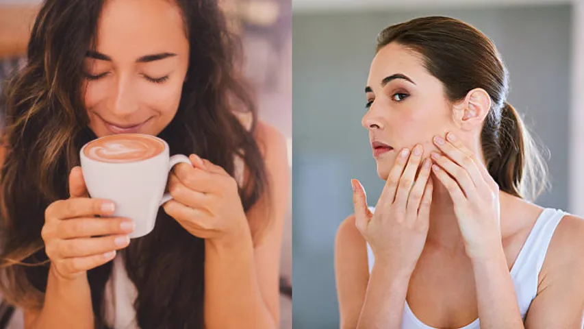 Coffee:  కాఫీ తాగితే ముఖంపై మొటిమలు వస్తాయా? ఇది నిజమేనా?