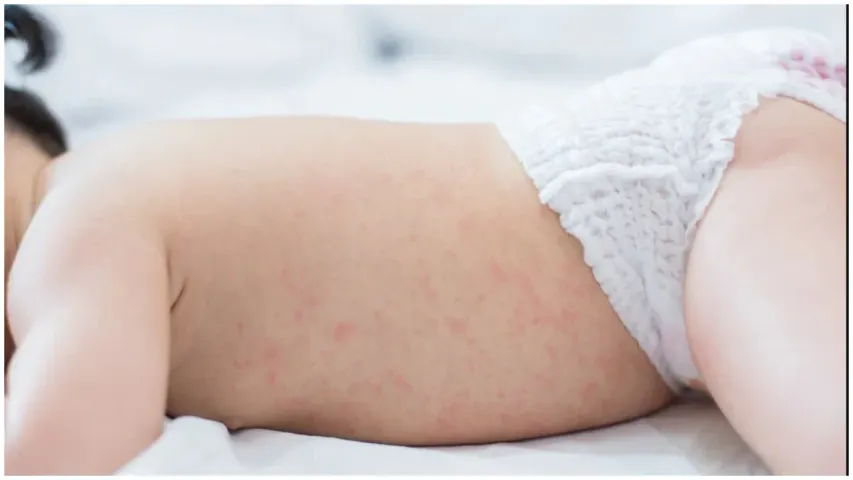 Baby Care : వేసవిలో పిల్లల చర్మం పై వేడి దద్దుర్లు ఎందుకు వస్తాయి.? తప్పక తెలుసుకోండి..!