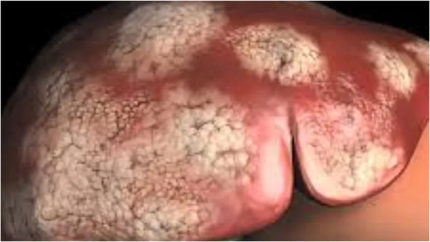 Liver Cancer: ఇలాంటి లక్షణాలు కాలేయ క్యాన్సర్‌కు సంకేతం.. తెలుసుకుంటే షాకే!