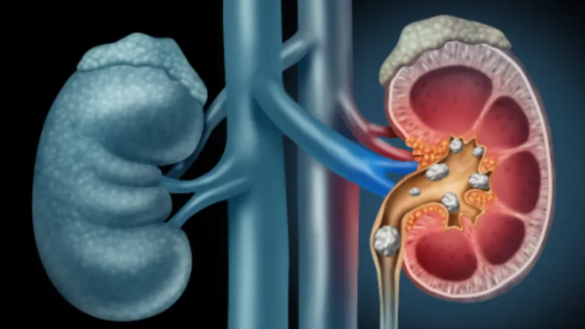 Health Tips: తక్కువ నీరు తాగడం వల్ల తీవ్రమైన కిడ్నీ వ్యాధి సంభవిస్తుంది...రోజులో ఎంత నీరు తాగాలంటే!