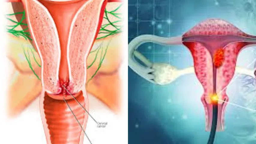 Cervical Cancer: వ్యాక్సిన్ తీసుకున్న తర్వాత గర్భాశయ క్యాన్సర్ ముప్పు తగ్గుతుందా? ఇందులో నిజమెంతా?