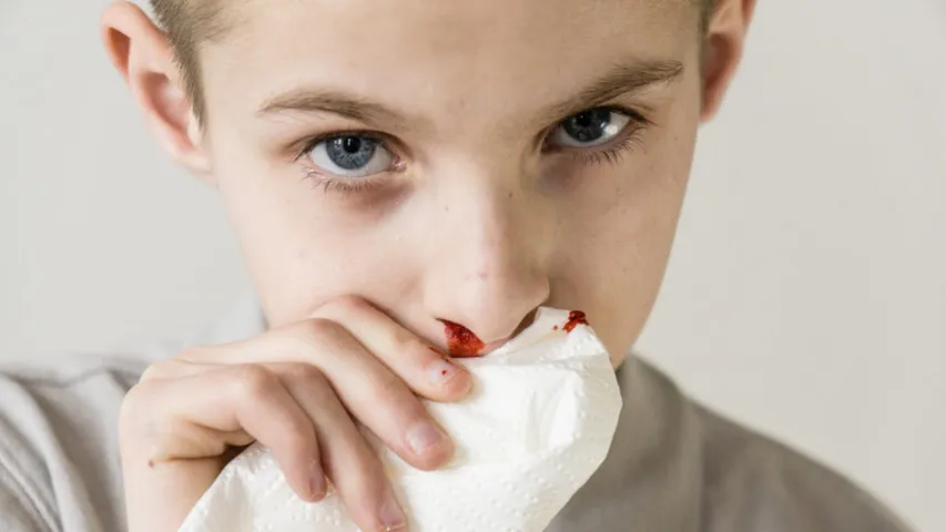 Nose Bleeding: వేసవిలో ముక్కు నుంచి బ్లడ్ వస్తుందా .. ఇలా చేయండి..!