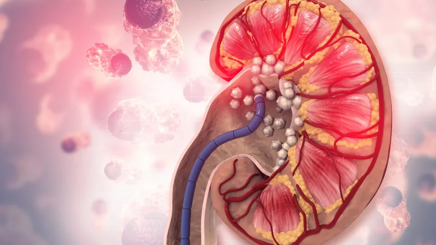 Kidney Stones: వేడి కారణంగా కిడ్నీలో స్టోన్లు పెరుగుతాయా? ఇందులో నిజమేంటి?