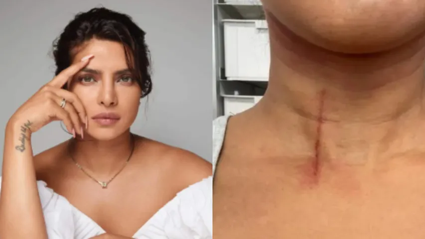 Priyanka Chopra : షూటింగ్‌ లో గాయపడిన బాలీవుడ్‌ ముద్దుగుమ్మ!