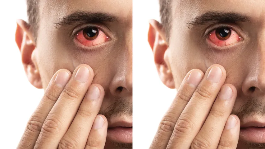 conjunctivitis: వర్షాకాలంలో కండ్లకలక ప్రమాదం..  కారణాలు, లక్షణాలు ఇవే..?