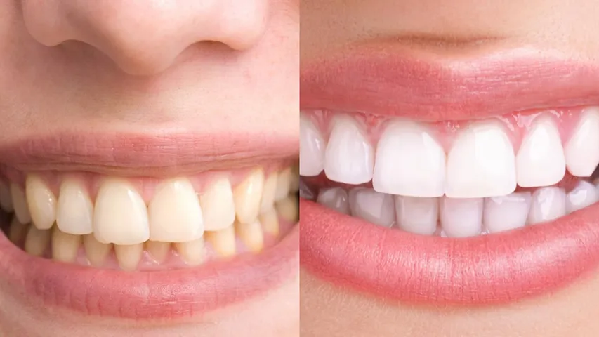 Healthy Teeth: ఈ నాలుగు పండ్లు తింటే పచ్చని పళ్ళు తళతళ మెరుస్తాయి..?