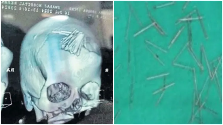 Odisha: యువతి తలకు 70 సూదులు గుచ్చిన మాంత్రికుడు.. చివరికీ ఏమైదంటే!