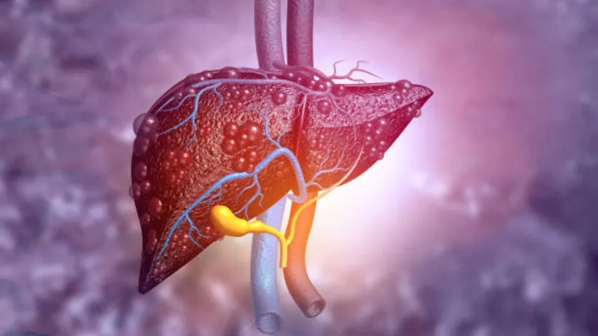 Liver Disease: దేశంలో ప్రతి మూడో వ్యక్తికి ఈ వ్యాధి వస్తుంది.. షాకింగ్‌ నిజాలు!