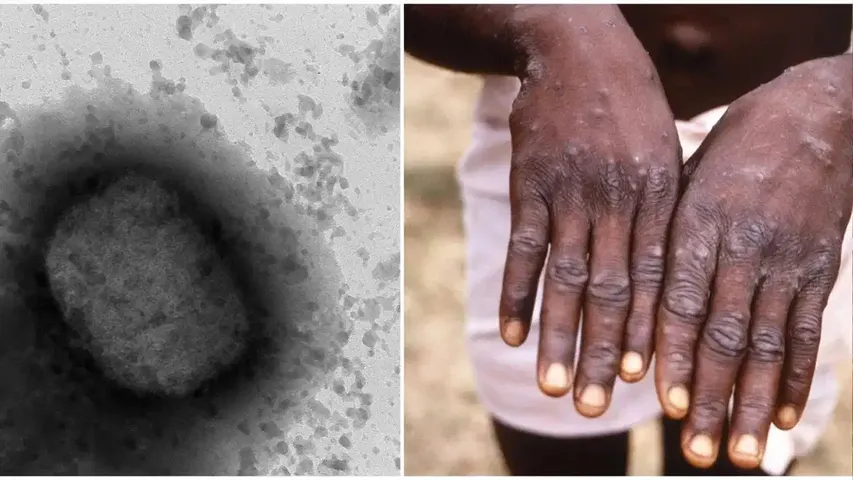 Monkey Pox : డేంజర్ బెల్స్.. పాకిస్తాన్ లో ఐదో మంకీ పాక్స్ రోగి