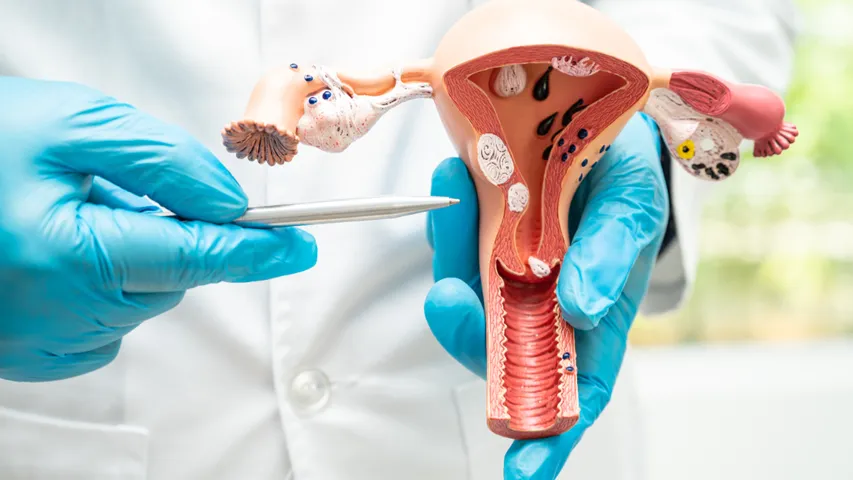 Ovarian Cancer: అండాశయ క్యాన్సర్‌ గురించి అసలు నిజం తెలుసుకోండి!