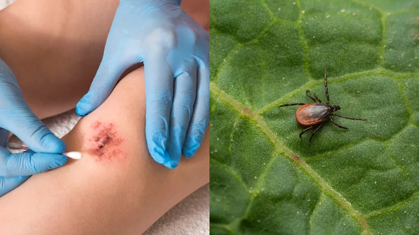 Lyme Disease: ఎర్రటి దద్దుర్లతో పాటు దురద.. మరణానికి దారి తీసే ఈ వ్యాధి గురించి తెలుసా!