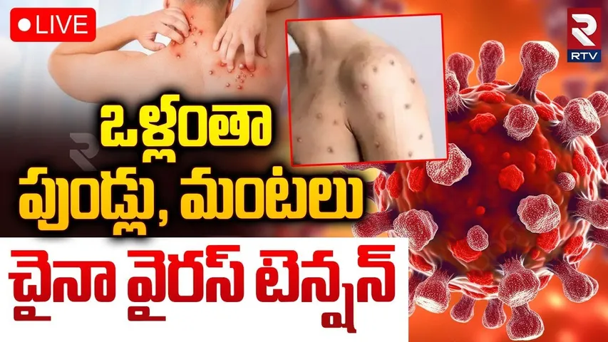 ఒళ్లంతా పుండ్లు చైనా వైరస్ టెన్షన్ 🔴LIVE :  Red Alert To India |  HMPV Virus Tension in China | RTV