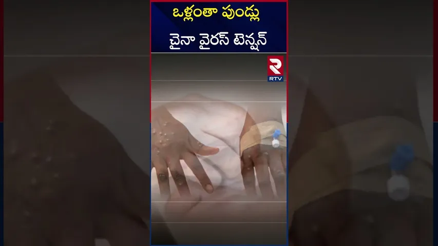 భారత్ కు కొత్త వైరస్ టెన్షన్ | HMPV Virus Tension in China | RTV