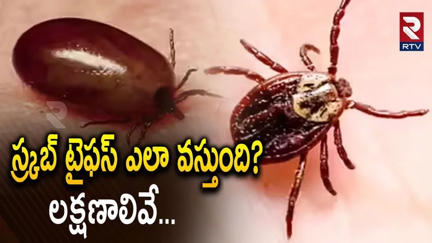 స్క్రబ్ టైఫస్ లక్షణాలివే... | Scrub Tyfus Causes And Symptoms | AP Scrub Tyfus Cases | RTV