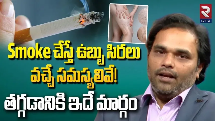 Dr Avinash About Varicose Veins Remedies | ఉబ్బు సిరలు తగ్గడానికి ఇదే మార్గం | Avis Hospital | RTV