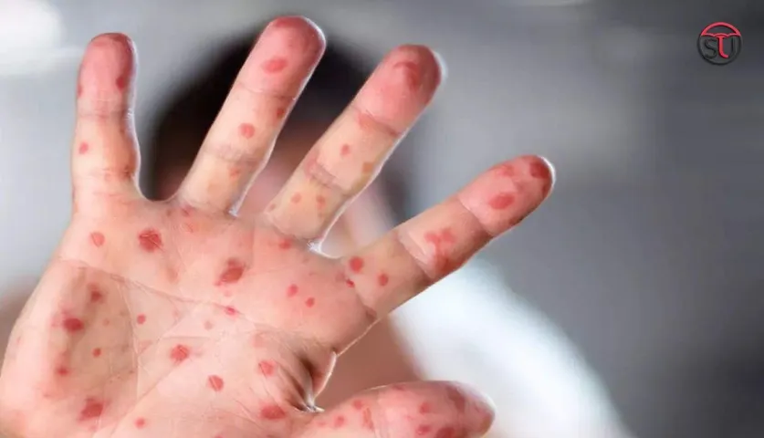 Monkeypox Outbreaks around the World: Know its Symptoms and Causes