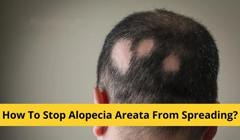 Alopecia Areata: A serious disease associated with hair loss, causes, symptoms and treatment