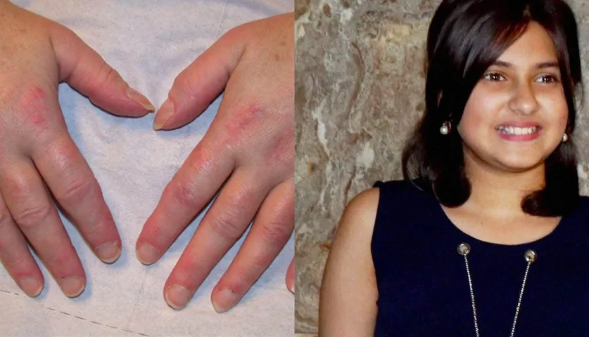 What is Dermatomyositis That Takes the Life of Dangal Actress Suhani Bhatnagar