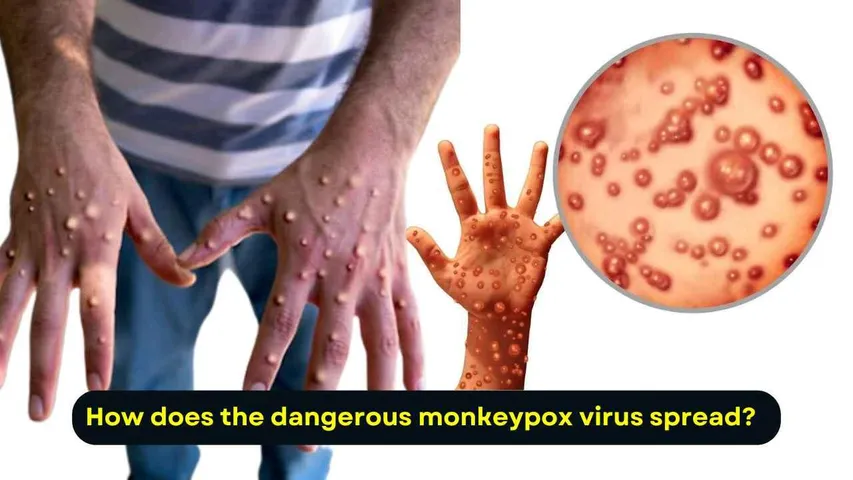 Understanding Monkeypox: Symptoms, Transmission, and How to Stay Safe
