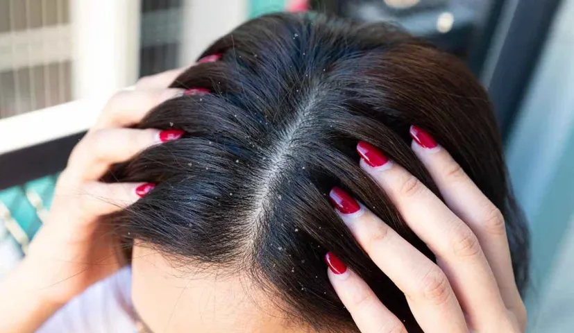 If You Are Troubled by the Problem of Dandruff, Then This Oil Made of Camphor (kapur) Will Give you Relief