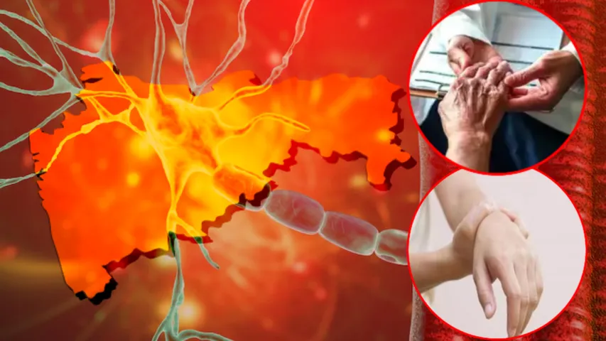 guillain barre syndrome