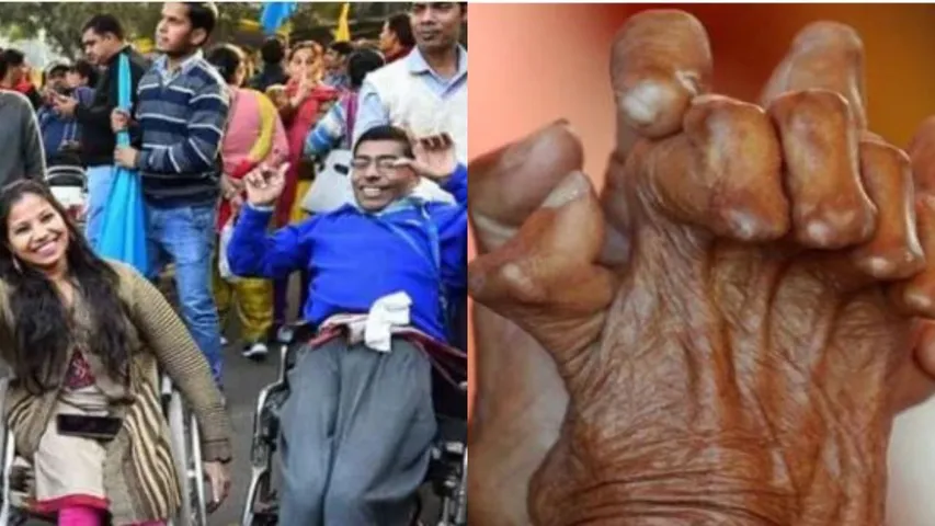 UP govt working empowerment disabled upliftment people affected leprosy