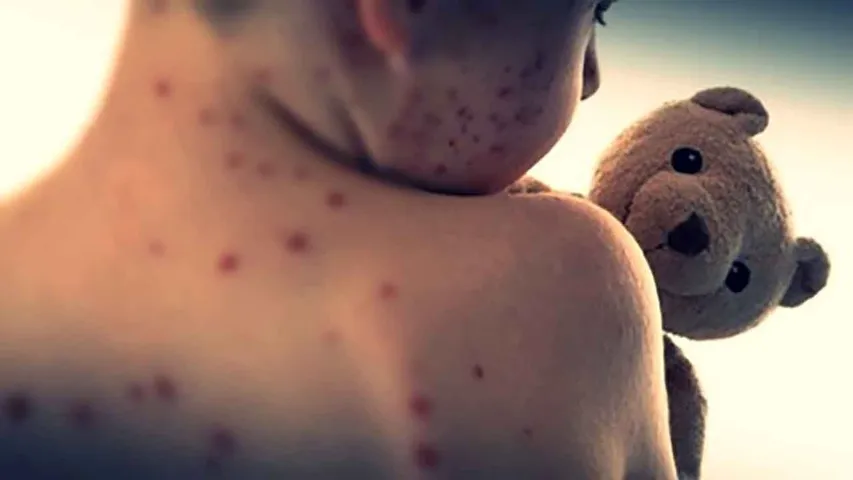 measles