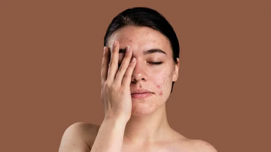 Pimples on Face