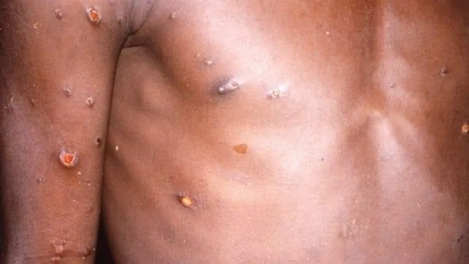 মাঙ্কিপক্স: সংযুক্ত আরব আমিরশাহীতে আরও ৩টি মামলার রিপোর্ট করা হয়েছে