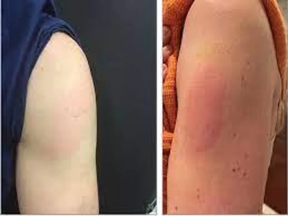 কোভিড আর্ম হলে কীভাবে সুস্থ হবেন?