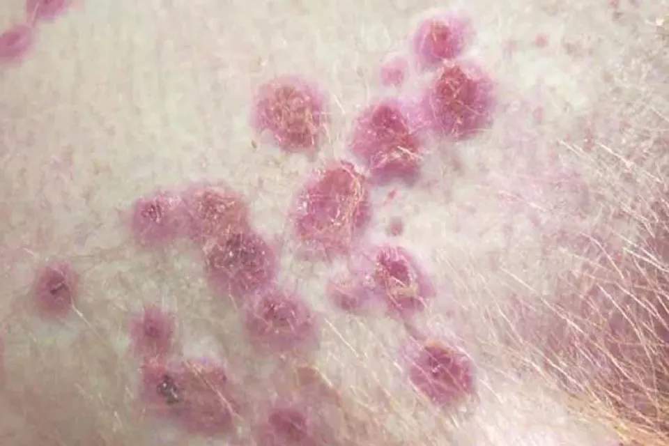 মাঙ্কিপক্স পরিস্থিতি নিরীক্ষণের জন্য গঠিত হল টাস্ক ফোর্স