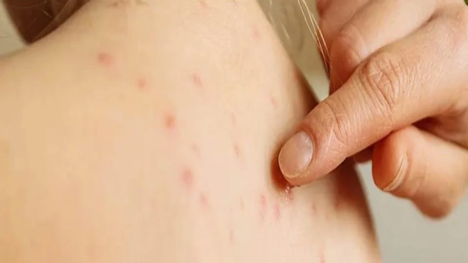 মাঙ্কিপক্স সন্দেহকে মিথ্যে প্রমাণ করলো চিকেনপক্স