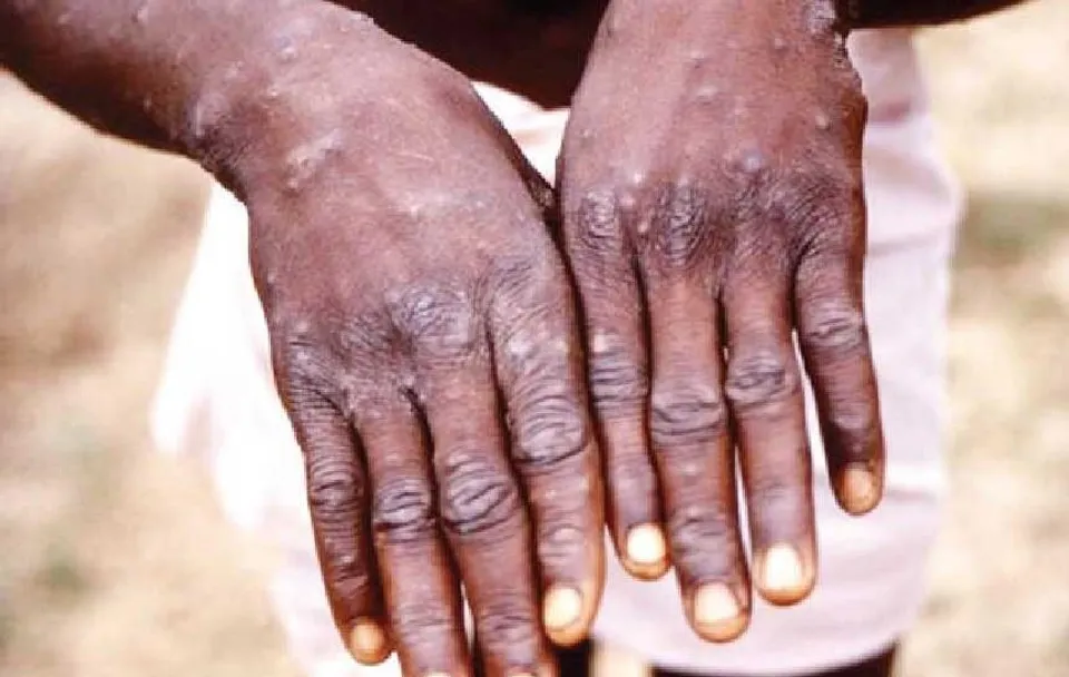 মাঙ্কি পক্সের হানা ঠেকাতে কড়া পদক্ষেপ কেন্দ্রের