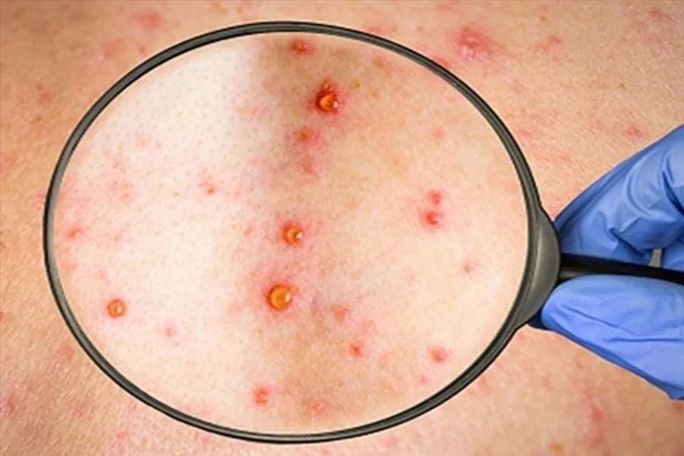 কেরলে মাঙ্কিপক্সে আক্রান্তের সংখ্যা আরো একজন বাড়লো