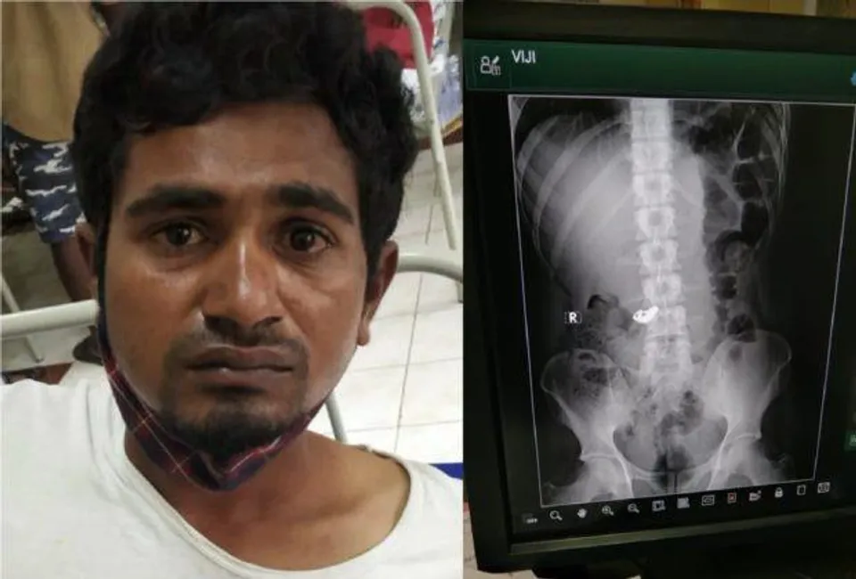 সোনার চেন গিলে নিল চোর, তারপর.........